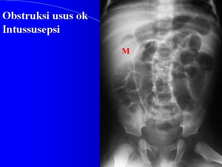 Obstruksi usus ok Intussusepsi 