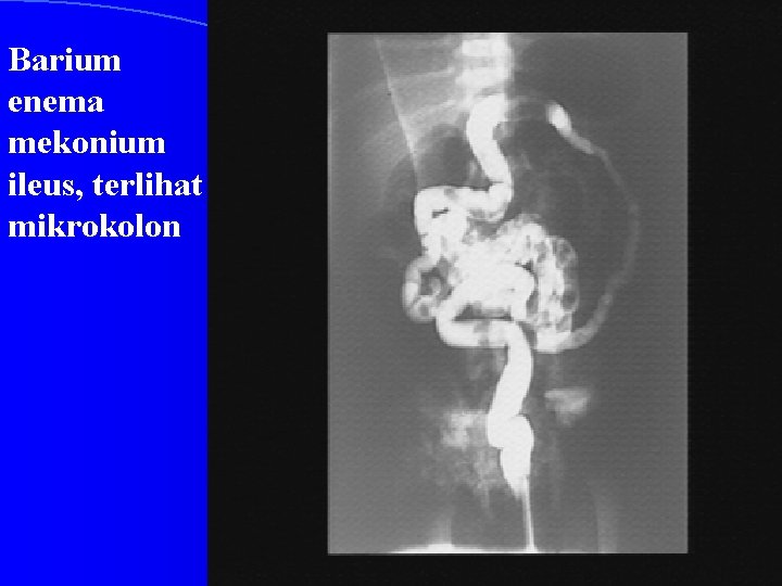 Barium enema mekonium ileus, terlihat mikrokolon 