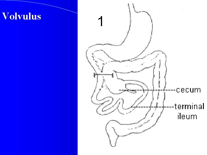 Volvulus 