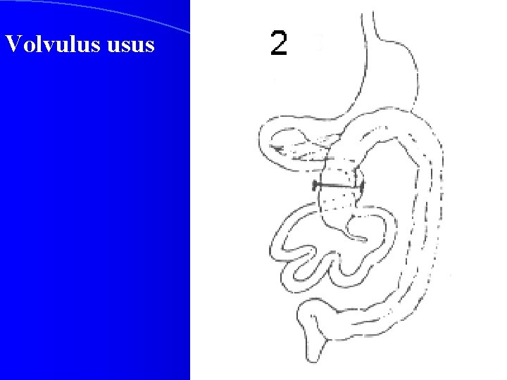 Volvulus usus 