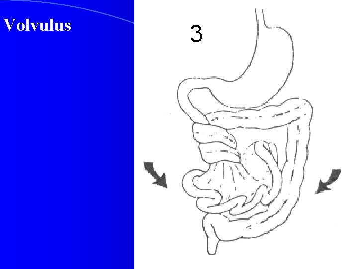 Volvulus 