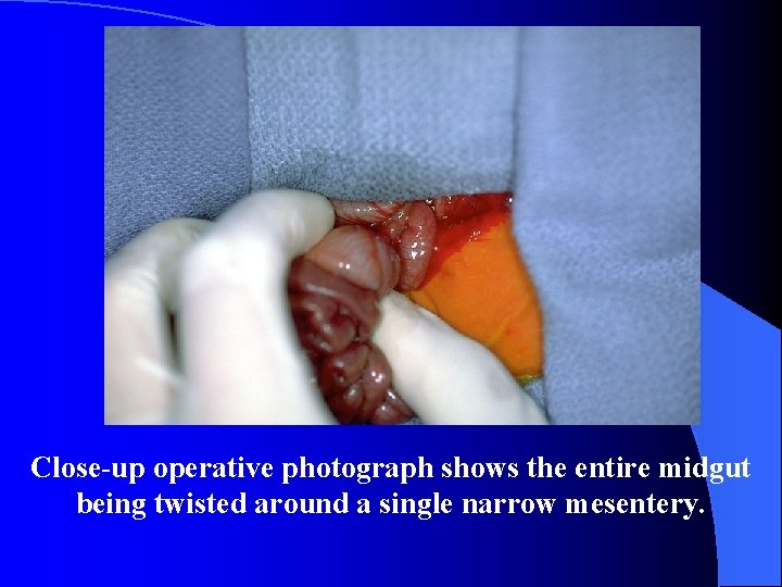 Close-up operative photograph shows the entire midgut being twisted around a single narrow mesentery.