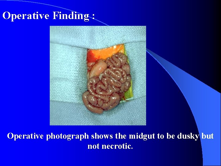 Operative Finding : Operative photograph shows the midgut to be dusky but not necrotic.