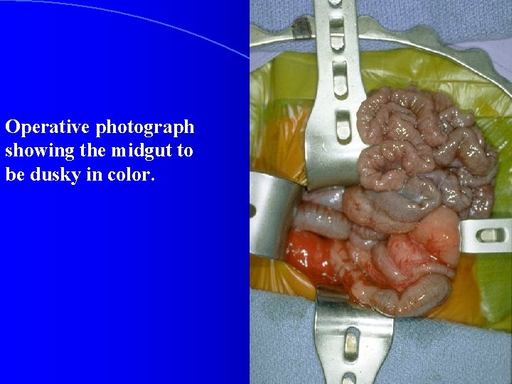 Operative photograph showing the midgut to be dusky in color. 