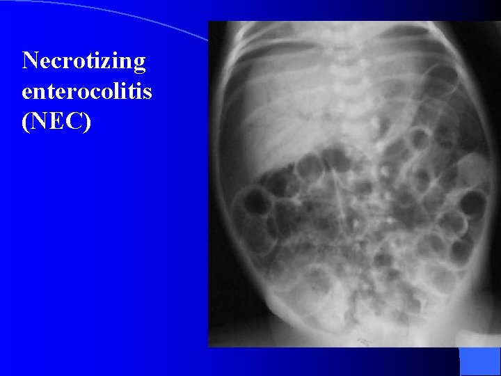 Necrotizing enterocolitis (NEC) 