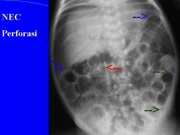 NEC Perforasi 