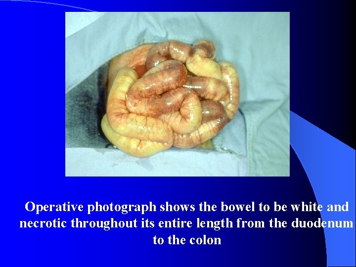 Operative photograph shows the bowel to be white and necrotic throughout its entire length