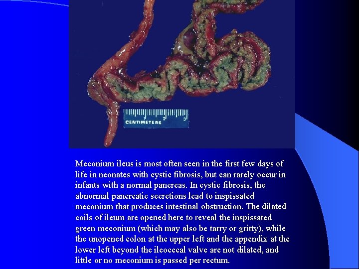 Meconium ileus is most often seen in the first few days of life in