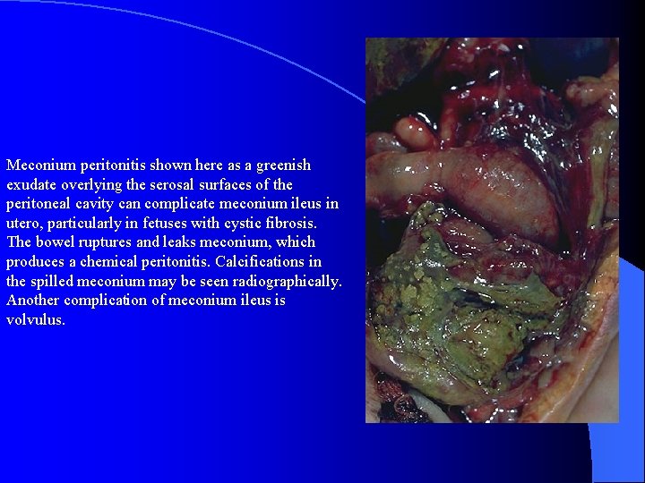 Meconium peritonitis shown here as a greenish exudate overlying the serosal surfaces of the