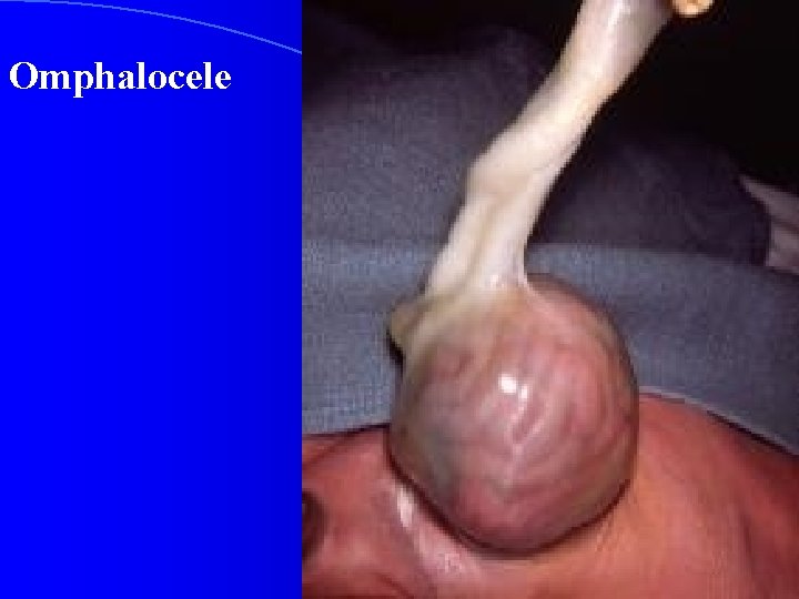 Omphalocele 