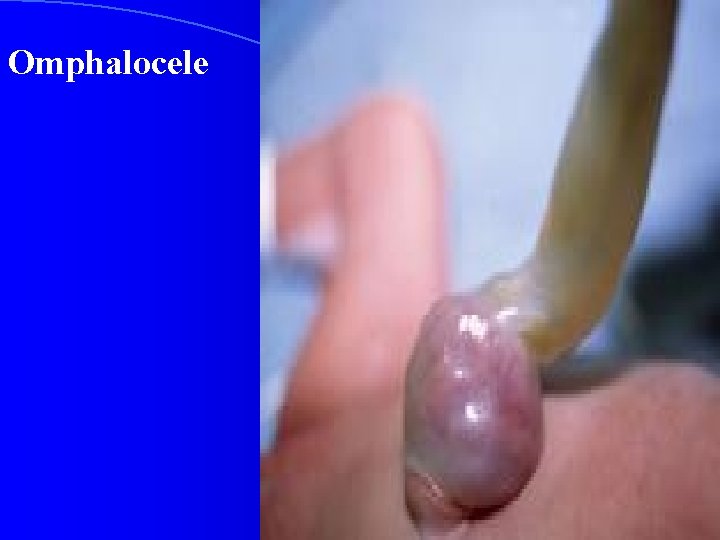 Omphalocele 