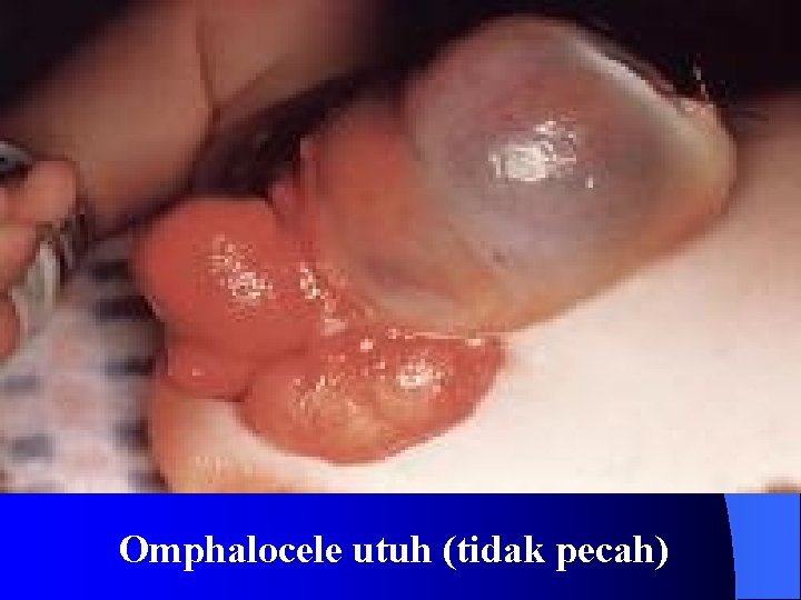 Omphalocele utuh (tidak pecah) 