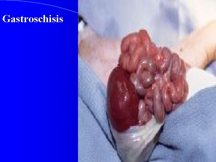 Gastroschisis 