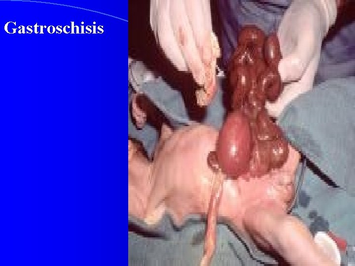 Gastroschisis 