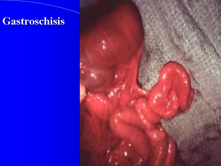 Gastroschisis 