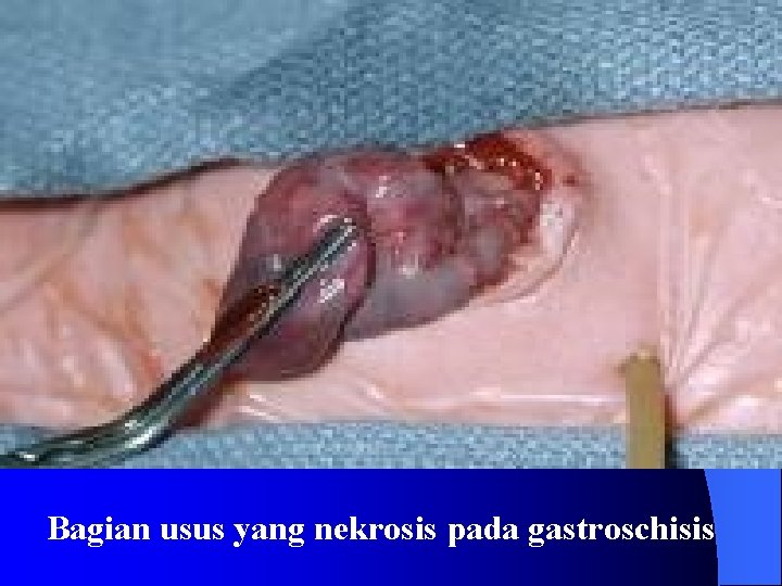 Bagian usus yang nekrosis pada gastroschisis 