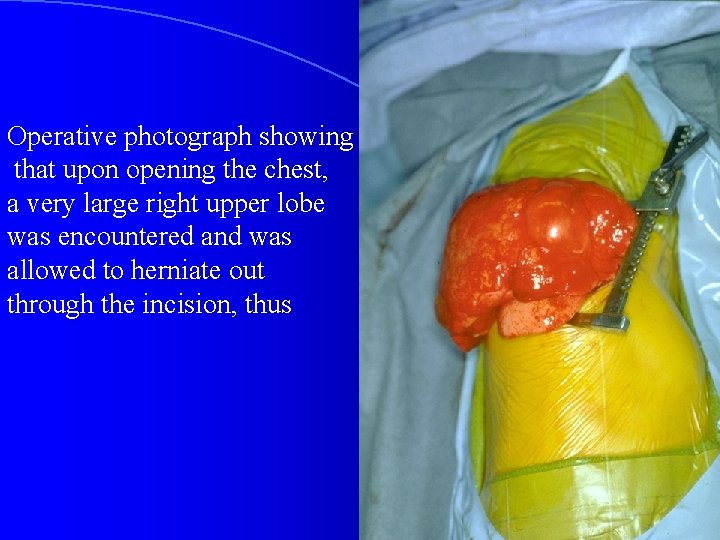 Operative photograph showing that upon opening the chest, a very large right upper lobe