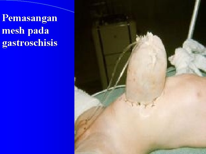 Pemasangan mesh pada gastroschisis 