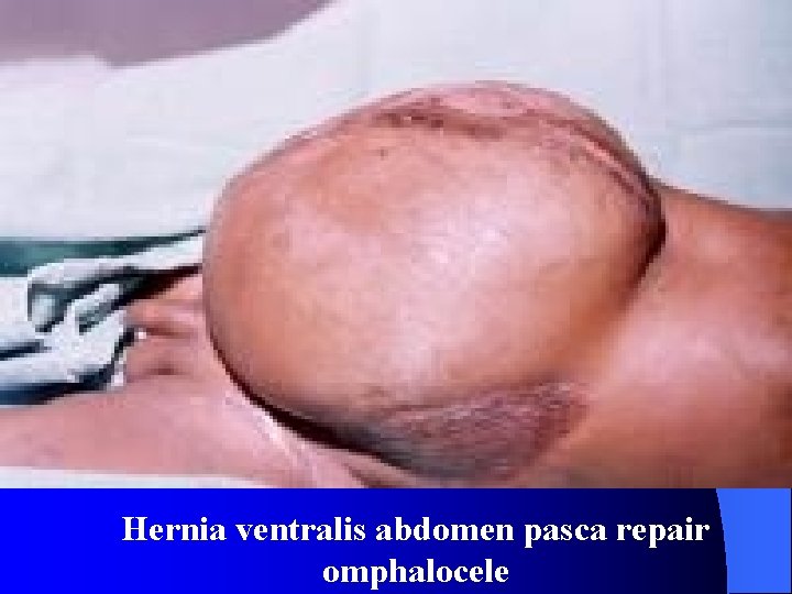 Hernia ventralis abdomen pasca repair omphalocele 