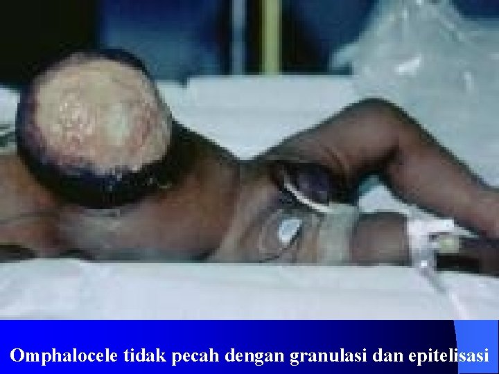 Omphalocele tidak pecah dengan granulasi dan epitelisasi 