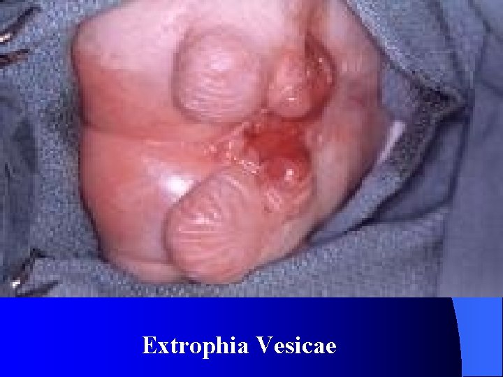 Extrophia Vesicae 