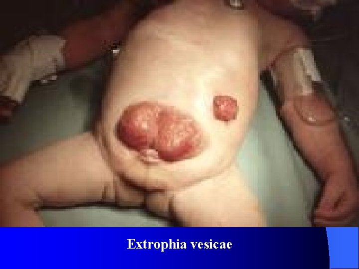 Extrophia vesicae 