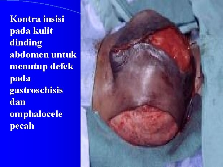 Kontra insisi pada kulit dinding abdomen untuk menutup defek pada gastroschisis dan omphalocele pecah