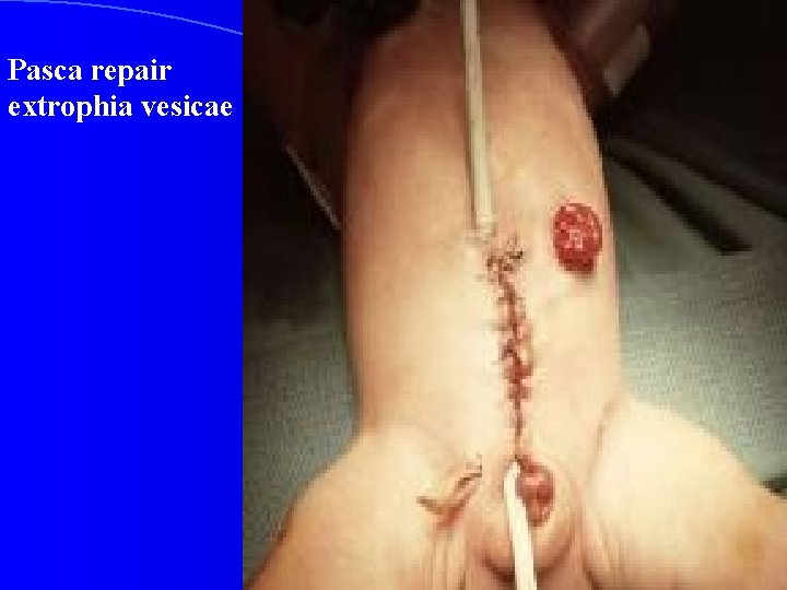 Pasca repair extrophia vesicae 