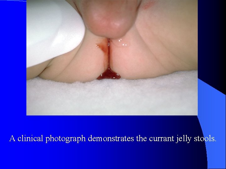 A clinical photograph demonstrates the currant jelly stools. 