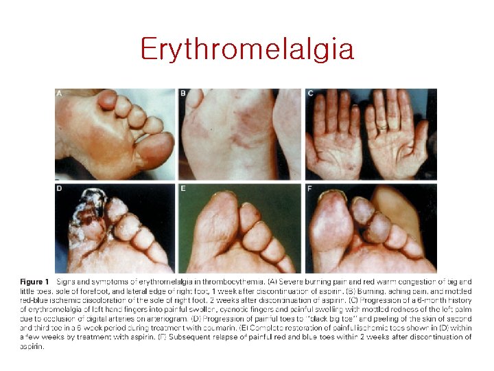 Erythromelalgia 