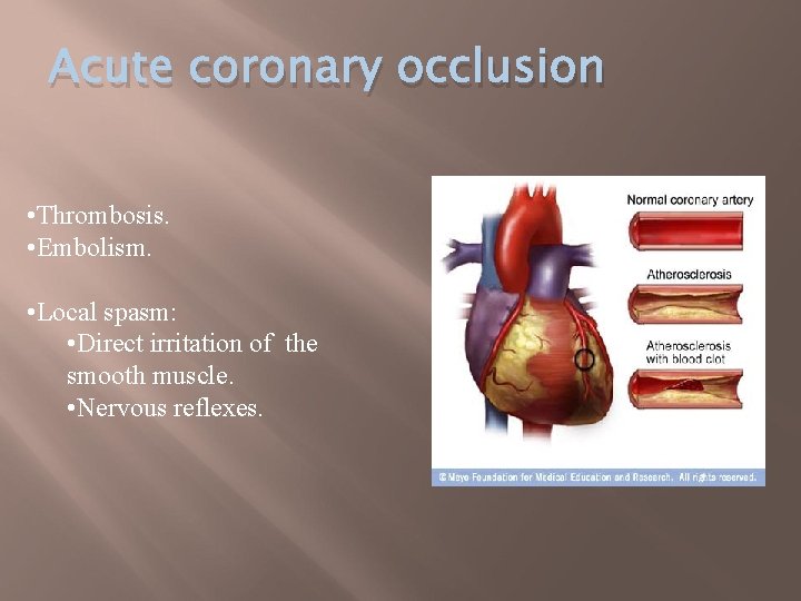 Acute coronary occlusion • Thrombosis. • Embolism. • Local spasm: • Direct irritation of