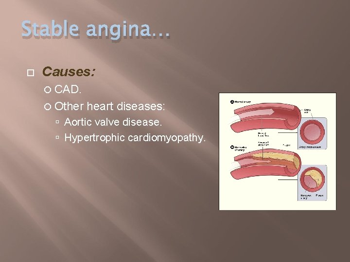 Stable angina… Causes: CAD. Other heart diseases: Aortic valve disease. Hypertrophic cardiomyopathy. 