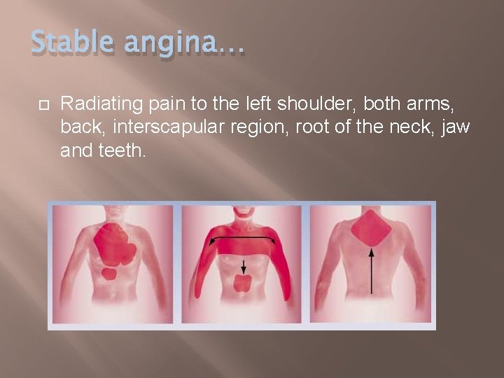 Stable angina… Radiating pain to the left shoulder, both arms, back, interscapular region, root