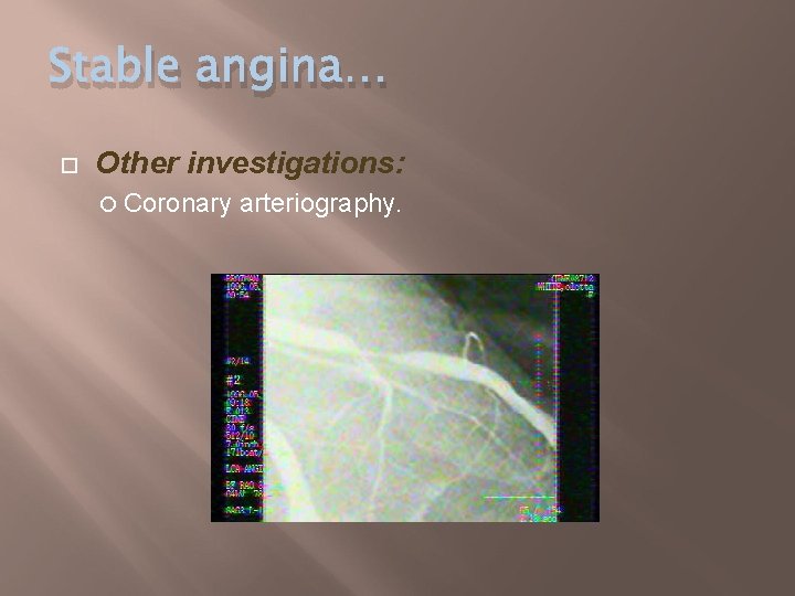 Stable angina… Other investigations: Coronary arteriography. 