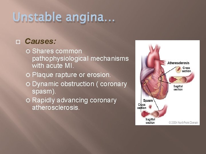Unstable angina… Causes: Shares common pathophysiological mechanisms with acute MI. Plaque rapture or erosion.