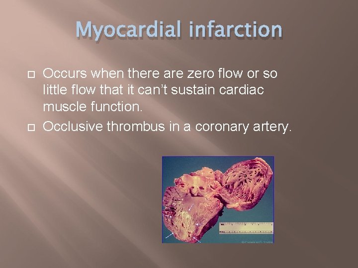 Myocardial infarction Occurs when there are zero flow or so little flow that it