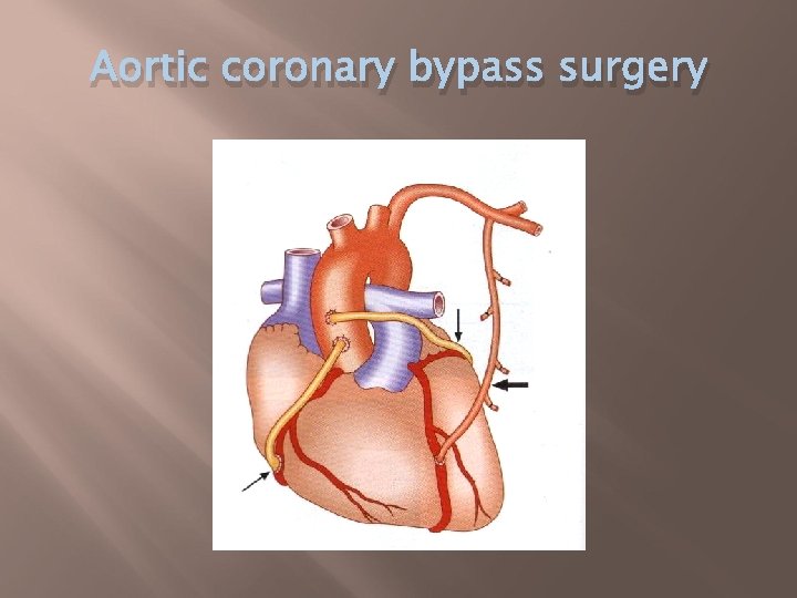 Aortic coronary bypass surgery 