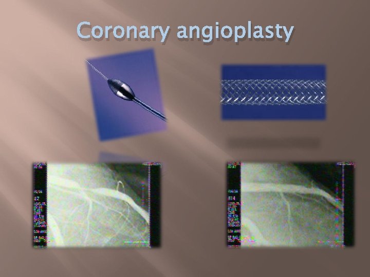 Coronary angioplasty 