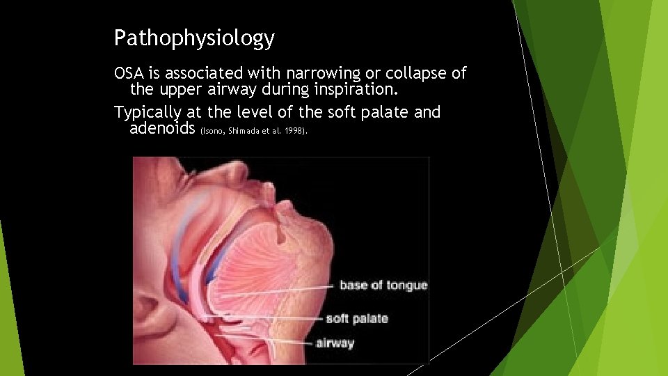 Pathophysiology OSA is associated with narrowing or collapse of the upper airway during inspiration.