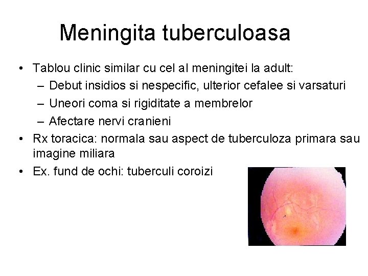 Meningita tuberculoasa • Tablou clinic similar cu cel al meningitei la adult: – Debut