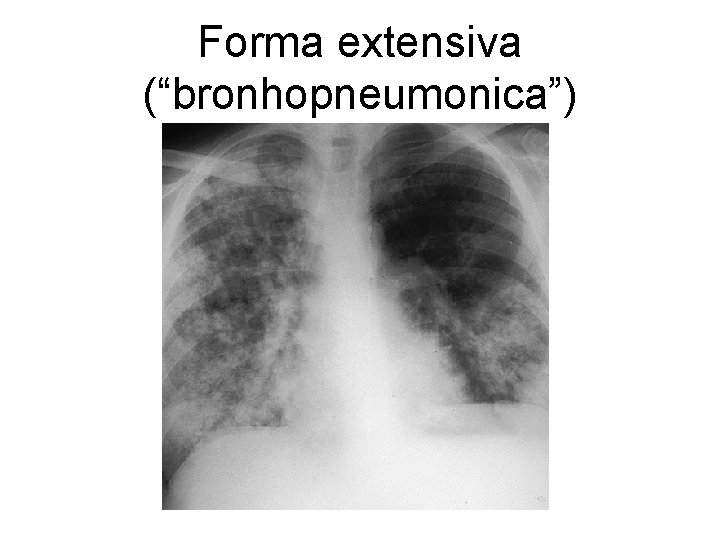 Forma extensiva (“bronhopneumonica”) 