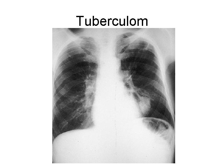 Tuberculom 