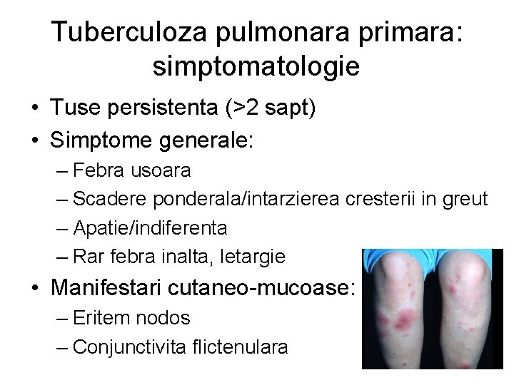 Tuberculoza pulmonara primara: simptomatologie • Tuse persistenta (>2 sapt) • Simptome generale: – Febra