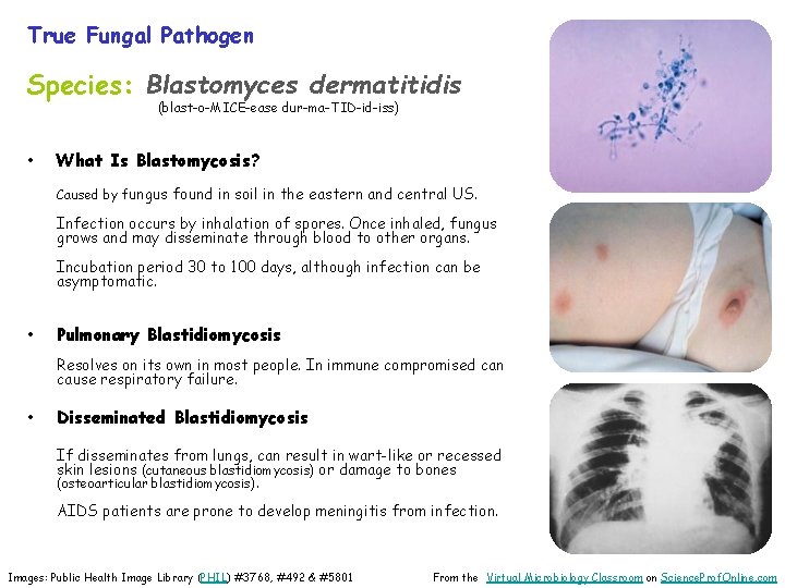 True Fungal Pathogen Species: Blastomyces dermatitidis (blast-o-MICE-ease dur-ma-TID-id-iss) • What Is Blastomycosis? Caused by