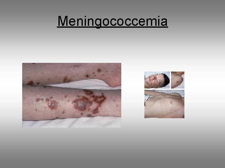 Meningococcemia 