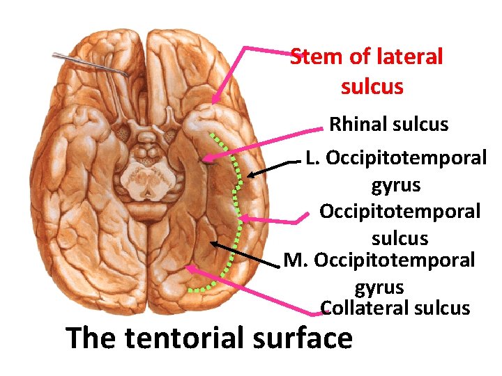 Stem of lateral sulcus Rhinal sulcus L. Occipitotemporal gyrus Occipitotemporal sulcus M. Occipitotemporal gyrus