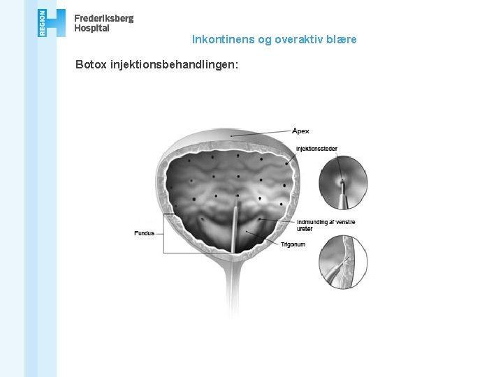 Inkontinens og overaktiv blære Botox injektionsbehandlingen: 