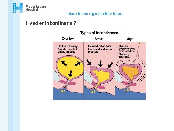 Inkontinens og overaktiv blære Hvad er inkontinens ? 