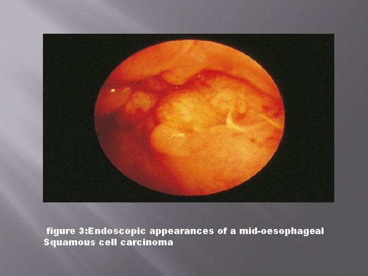 figure 3: Endoscopic appearances of a mid-oesophageal Squamous cell carcinoma 