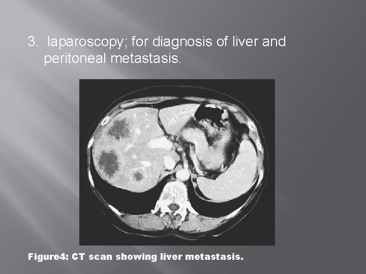 3. laparoscopy; for diagnosis of liver and peritoneal metastasis. Figure 4: CT scan showing